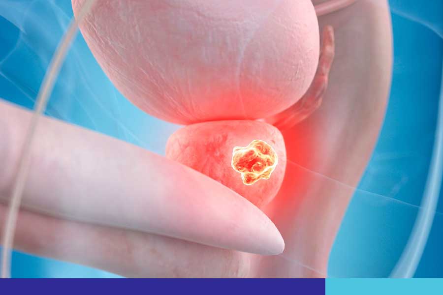 Conheça os tratamentos minimamente invasivos para a Hiperplasia Benigna da Próstata (HBP)